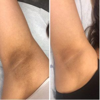Full Body Exfoliating Peel Shot Spray – For Soft, Smooth Skin